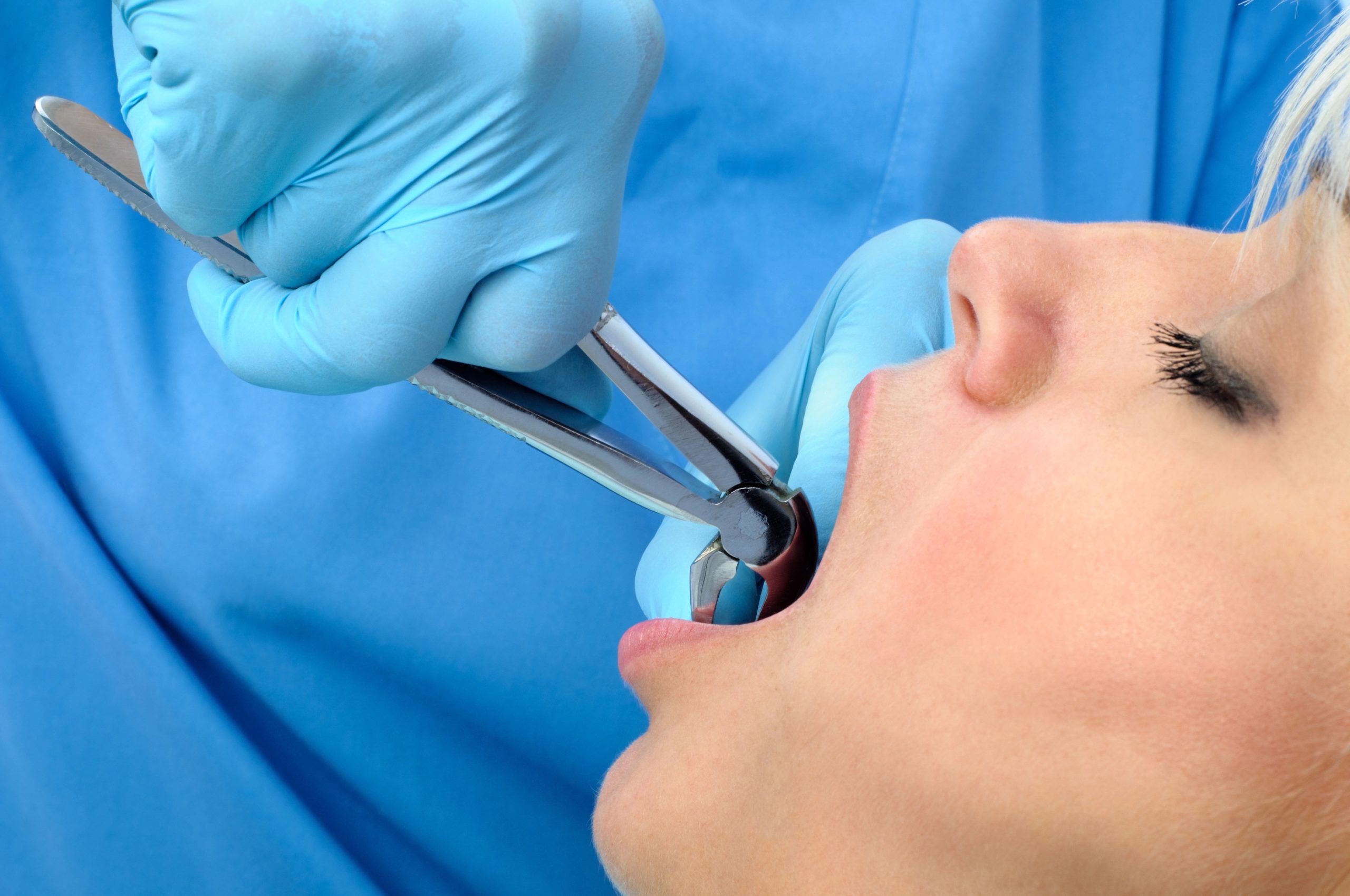 Tooth Extraction Procedure: Step-by-Step Guide