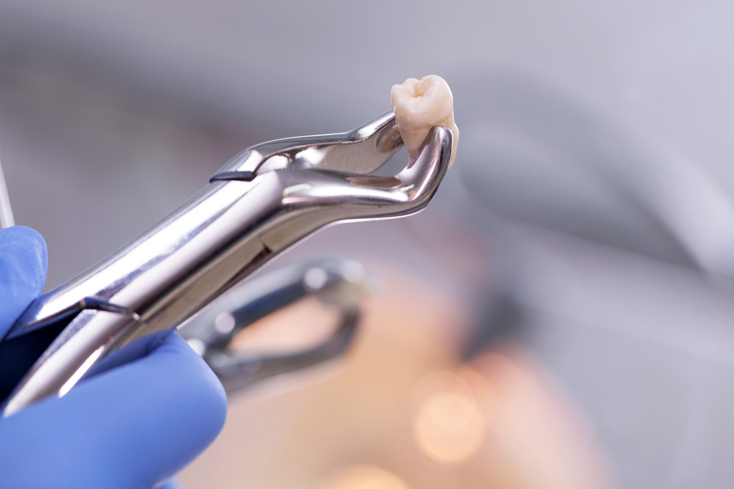 Tooth Extraction Recovery Tips: Quick Healing